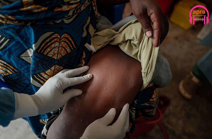 L'OMS met en place une stratégie mondiale de vaccination pour limiter le mpox en Afrique
