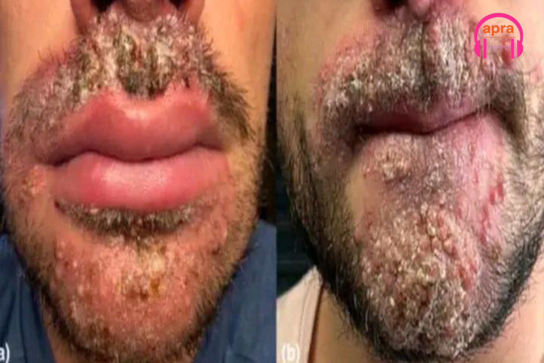 SANTÉ / TMVII : cette infection fongique à transmission sexuelle qui inquiète les États-Unis et bouscule les certitudes médicales.