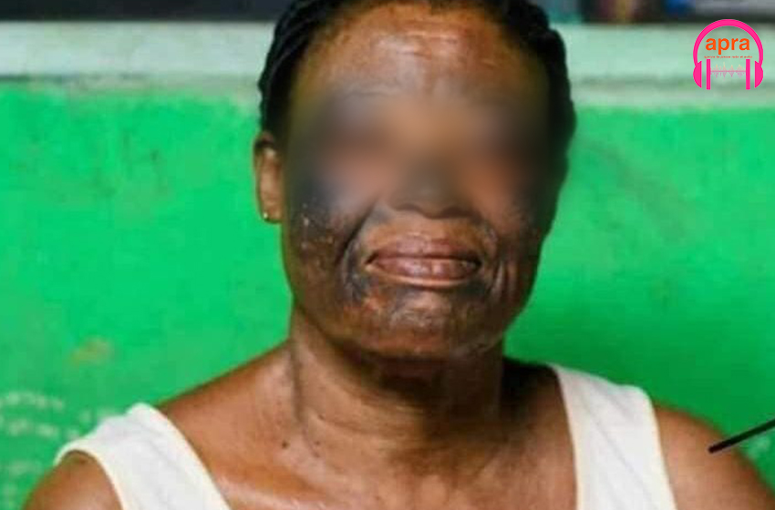 Publi-reportage : la dépigmentation volontaire de la peau, un danger pour ceux qui la pratiquent.