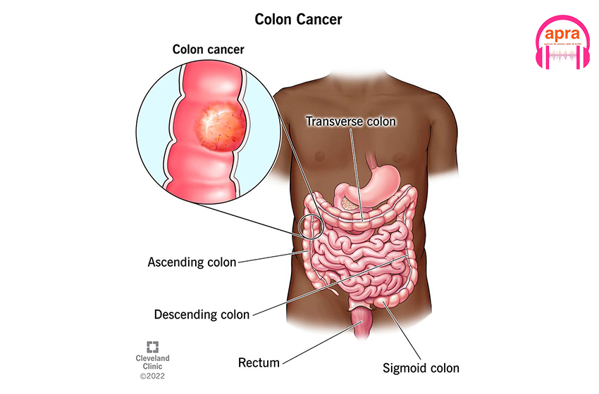 Santé : cancer colorectal, la maladie la plus fréquente chez les hommes homosexuels